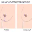 Lifestyle Changes After a Breast Reduction