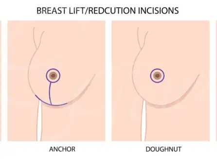 Lifestyle Changes After a Breast Reduction