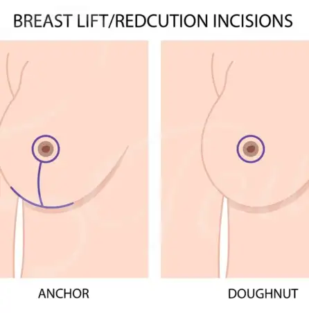 Lifestyle Changes After a Breast Reduction