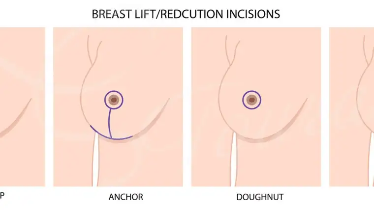 Lifestyle Changes After a Breast Reduction
