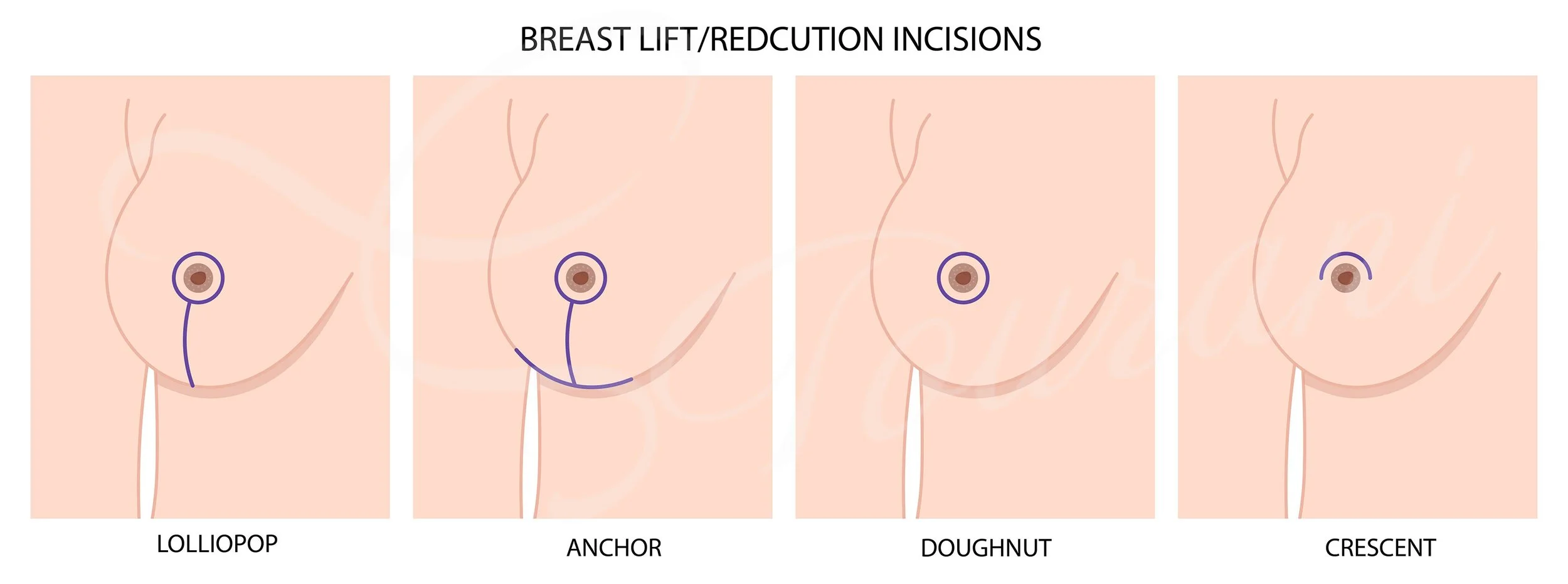 Lifestyle Changes After a Breast Reduction